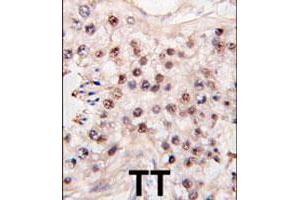 Formalin-fixed and paraffin-embedded human testicle tumor tissue reacted with HDAC11 polyclonal antibody  , which was peroxidase-conjugated to the secondary antibody, followed by DAB staining. (HDAC11 Antikörper  (C-Term))