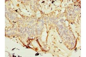 Immunohistochemistry of paraffin-embedded human breast cancer using ABIN7176140 at dilution of 1:100 (ZNF19 Antikörper  (AA 1-200))