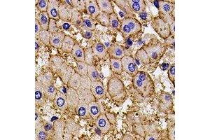 Immunohistochemical analysis of AP2-alpha-2 staining in human liver cancer formalin fixed paraffin embedded tissue section. (AP2A2 Antikörper)