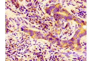 Immunohistochemistry of paraffin-embedded human pancreatic cancer using ABIN7145263 at dilution of 1:100 (BCAM Antikörper  (AA 447-547))