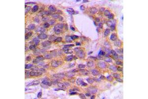 Immunohistochemical analysis of PKC theta (pS676) staining in human breast cancer formalin fixed paraffin embedded tissue section.