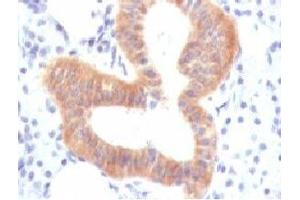 IHC testing of FFPE human melanoma with CD86 antibody (clone CDLA86). (CD86 Antikörper)