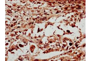 IHC image of ABIN7150959 diluted at 1:600 and staining in paraffin-embedded human melanoma performed on a Leica BondTM system. (NSMCE2 Antikörper  (AA 1-247))