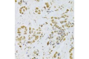 Immunohistochemistry of paraffin-embedded human breast cancer using HMGB1 Antibody. (HMGB1 Antikörper  (AA 100-200))