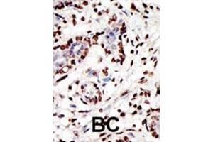 Formalin-fixed and paraffin-embedded human cancer tissue reacted with the primary antibody, which was peroxidase-conjugated to the secondary antibody, followed by AEC staining. (MLL/KMT2A Antikörper  (C-Term))