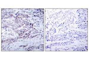 Immunohistochemical analysis of paraffin-embedded human breast carcinoma tissue using NF-κ,B p100(phospho- Ser870) antibody. (NFKB2 Antikörper  (pSer870))