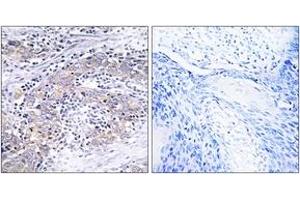 Immunohistochemistry analysis of paraffin-embedded human cervix carcinoma tissue, using CLN6 Antibody. (CLN6 Antikörper  (AA 221-270))