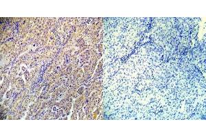 Immunohistochemical analysis of paraffin-embedded human lung carcinoma tissue using AMPKbeta1 (phospho-Ser182) (E012004). (PRKAB1 Antikörper  (pSer182))