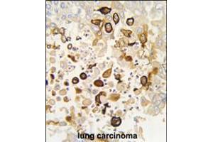 Formalin-fixed and paraffin-embedded human lung carcinoma tissue reacted with CYP4X1 antibody (N-term), which was peroxidase-conjugated to the secondary antibody, followed by DAB staining. (CYP4X1 Antikörper  (N-Term))