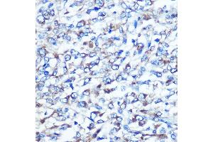 Immunohistochemistry of paraffin-embedded human liver cancer using OPTN Rabbit pAb (ABIN3015612, ABIN3015613, ABIN3015614 and ABIN6218972) at dilution of 1:100 (40x lens). (OPTN Antikörper  (AA 1-577))