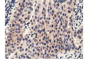 Immunohistochemical staining of paraffin-embedded Carcinoma of Human bladder tissue using anti-PRKD2 mouse monoclonal antibody. (PKD2 Antikörper)