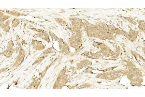 Immunohistochemical analysis of paraffin-embedded Human Breast cancer section using Pink1  8417b. (CDK5 Antikörper)