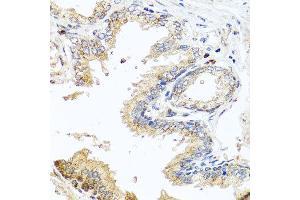 Immunohistochemistry of paraffin-embedded human prostate using MCCC2 antibody at dilution of 1:100 (x40 lens). (MCCC2 Antikörper)