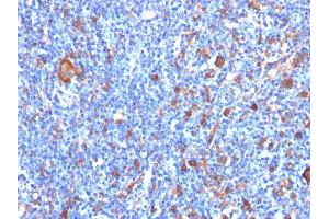 Formalin-fixed, paraffin-embedded human Hodgkin's Lymphoma stained with Fascin-1 Mouse Monoclonal Antibody (FSCN1/417) (Fascin Antikörper)