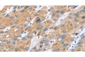 Immunohistochemistry of paraffin-embedded Human liver cancer tissue using ERVW-1 Polyclonal Antibody at dilution 1:45 (ERVW-1 Antikörper)