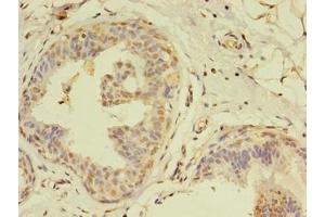 Immunohistochemistry of paraffin-embedded human breast cancer using ABIN7159241 at dilution of 1:100 (MLANA Antikörper  (AA 1-118))