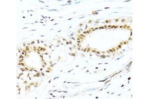 Immunohistochemistry of paraffin-embedded Human breast cancer using XRCC4 Polyclonal Antibody at dilution of 1:100 (40x lens). (XRCC4 Antikörper)