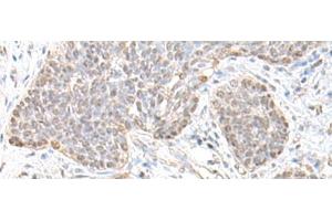 Immunohistochemistry of paraffin-embedded Human esophagus cancer tissue using TCF25 Polyclonal Antibody at dilution of 1:35(x200) (TCF25 Antikörper)