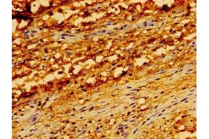 Immunohistochemistry of paraffin-embedded human melanoma using ABIN7173904 at dilution of 1: 100 (TRADD Antikörper  (AA 1-312))