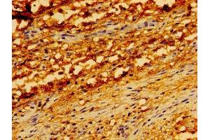 Immunohistochemistry of paraffin-embedded human melanoma using ABIN7173904 at dilution of 1: 100