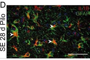 Immunostaining of mouse hippocampal CA1 region showing GFAP and IL1B labeling of astrocytes 28 days after pilocarpine induced status epilepticus (SE).
