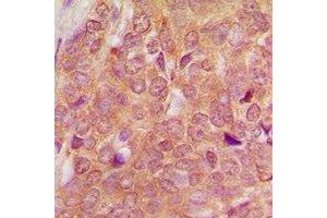 Immunohistochemical analysis of SEN54 staining in human breast cancer formalin fixed paraffin embedded tissue section. (TSEN54 Antikörper)