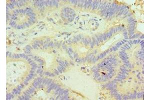 Immunohistochemistry of paraffin-embedded human colon cancer using ABIN7154051 at dilution of 1:100 (GLRX3 Antikörper  (AA 1-335))