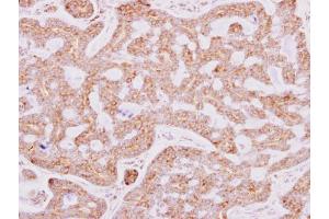IHC-P Image RPL15 antibody detects RPL15 protein at cytosol on human breast carcinoma by immunohistochemical analysis.