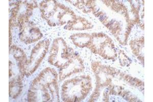 Immunohistochemistry (IHC) staining of Human colon cancer tissue paraffin-embedded, diluted at 1:200. (p53 Antikörper)