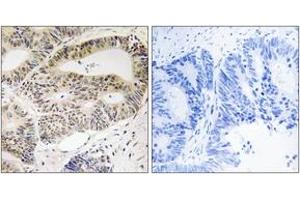 Immunohistochemistry analysis of paraffin-embedded human colon carcinoma tissue, using OSR1 (Ab-185) Antibody. (OSR1 Antikörper  (AA 151-200))