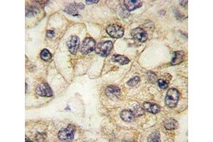 CD14 antibody used to stain FFPE human lung carcinoma (CD14 Antikörper  (AA 292-322))