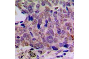 Immunohistochemical analysis of CREB staining in human breast cancer formalin fixed paraffin embedded tissue section. (CREB1 Antikörper  (Center))