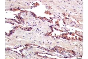 Formalin-fixed and paraffin embedded human prostate cancer labeled with Anti-PRSS8 Polyclonal Antibody, Unconjugated (ABIN761891) at 1:200 followed by conjugation to the secondary antibody and DAB staining (PRSS8 Antikörper  (AA 65-165))