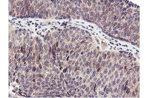 Immunohistochemical staining of paraffin-embedded Carcinoma of Human bladder tissue using anti-RFXANK mouse monoclonal antibody. (RFXANK Antikörper)