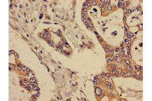 Immunohistochemistry of paraffin-embedded human pancreatic cancer using ABIN7145363 at dilution of 1:100 (GCNT3 Antikörper  (AA 250-419))