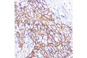 Immunohistochemistry of paraffin-embedded human esophageal cancer using NDRG1 Rabbit mAb (ABIN7268783) at dilution of 1:100 (40x lens).