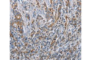Immunohistochemistry of Human gastric cancer using SOCS1 Polyclonal Antibody at dilution of 1:70