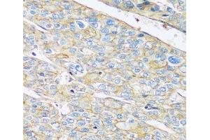 Immunohistochemistry of paraffin-embedded Human liver cancer using ARL4A Polyclonal Antibody at dilution of 1:100 (40x lens). (ARL4A Antikörper)