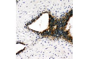 Anti-Annexin VIII antibody, IHC(P) IHC(P): Human Mammary Cancer Tissue (Annexin VII Antikörper  (C-Term))