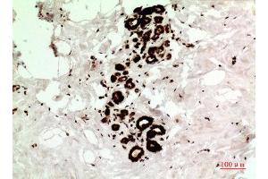 Immunohistochemistry (IHC) analysis of paraffin-embedded Human Breast Cancer, antibody was diluted at 1:100. (HSP70 Antikörper  (Ser102))