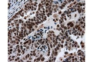 Immunohistochemical staining of paraffin-embedded Adenocarcinoma of breast tissue using anti-ACLY mouse monoclonal antibody. (ACLY Antikörper)