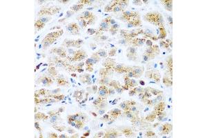 Immunohistochemistry of paraffin-embedded human liver cancer using KIAA1456 antibody (ABIN5974326) at dilution of 1/200 (40x lens). (KIAA1456 Antikörper)