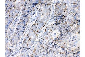 IHC testing of FFPE human lung cancer tissue with Bax antibody at 1ug/ml. (BAX Antikörper  (AA 17-48))
