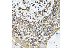Immunohistochemistry of paraffin-embedded human skin carcinoma using ICOSL Antibody (ABIN6130065, ABIN6142131, ABIN6142132 and ABIN6222879) at dilution of 1:100 (40x lens). (ICOSLG Antikörper  (AA 19-256))