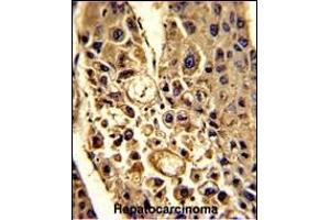 Formalin-fixed and paraffin-embedded human hepatocarcinoma with CFHL1 Antibody (C-term), which was peroxidase-conjugated to the secondary antibody, followed by DAB staining. (CFHR1 Antikörper  (C-Term))