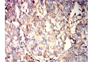 Immunohistochemical analysis of paraffin-embedded bladder cancer tissues using ALB mouse mAb with DAB staining. (Albumin Antikörper  (AA 410-609))