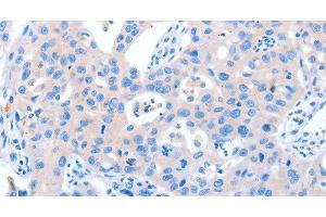 Immunohistochemistry of paraffin-embedded Human lung cancer tissue using NUAK1 Polyclonal Antibody at dilution 1:60 (NUAK1 Antikörper)