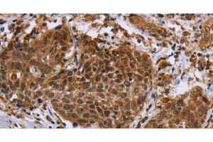 Immunohistochemistry of paraffin-embedded Human cervical cancer using DUSP8 Polyclonal Antibody at dilution of 1:30 (DUSP8 Antikörper)