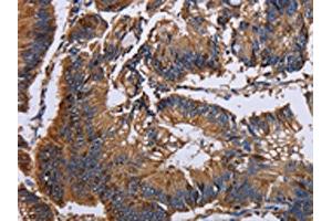 The image on the left is immunohistochemistry of paraffin-embedded Human colon cancer tissue using ABIN7130044(KRT31 Antibody) at dilution 1/30, on the right is treated with fusion protein. (Keratin 31 Antikörper)