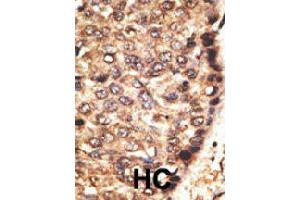 Formalin-fixed and paraffin-embedded human hepatocellular carcinoma tissue reacted with MMP24 polyclonal antibody  , which was peroxidase-conjugated to the secondary antibody, followed by AEC staining. (MMP24 Antikörper  (Internal Region))